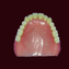 岡崎市 のじまデンタルクリニック プラスチック義歯